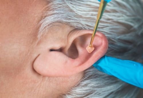 Auricular Therapy